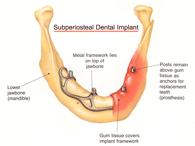 Implant Design