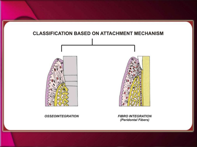 Implant Design