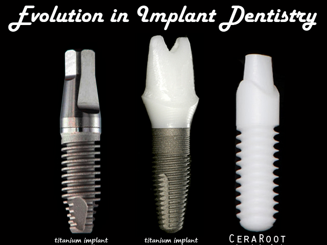 Implant Design