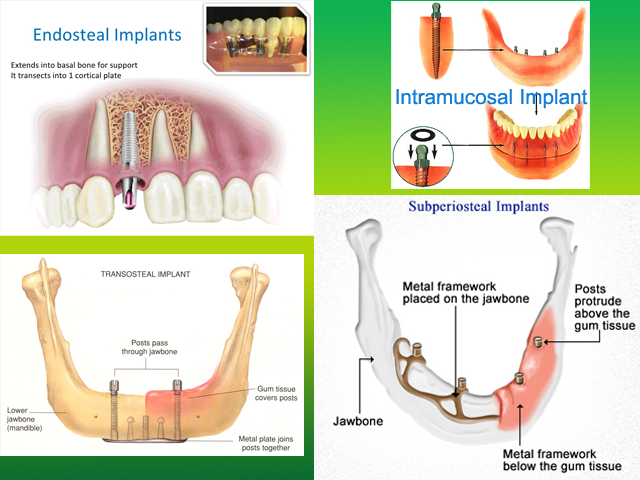 Implant Design