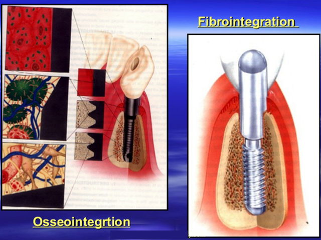 Implant Design