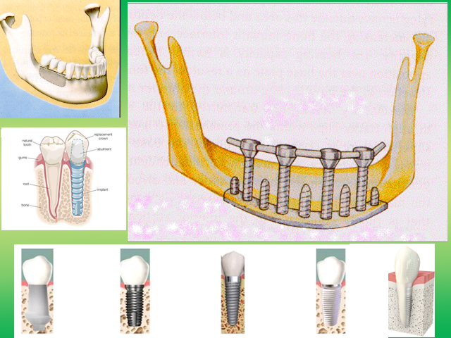 Implant Design