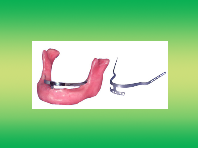 Implant Design