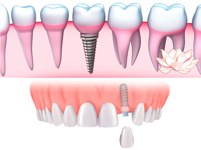 Implant Design