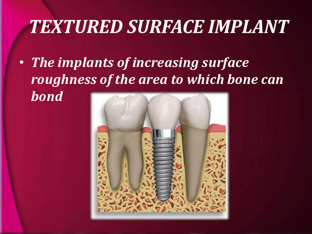 Implant Design